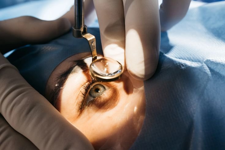 Glaucoma: The Silent Thief of Vision – What You Need to Know