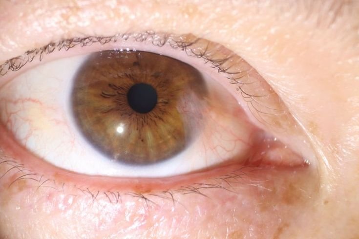 What Is a Pterygium and Does It Need Surgery?