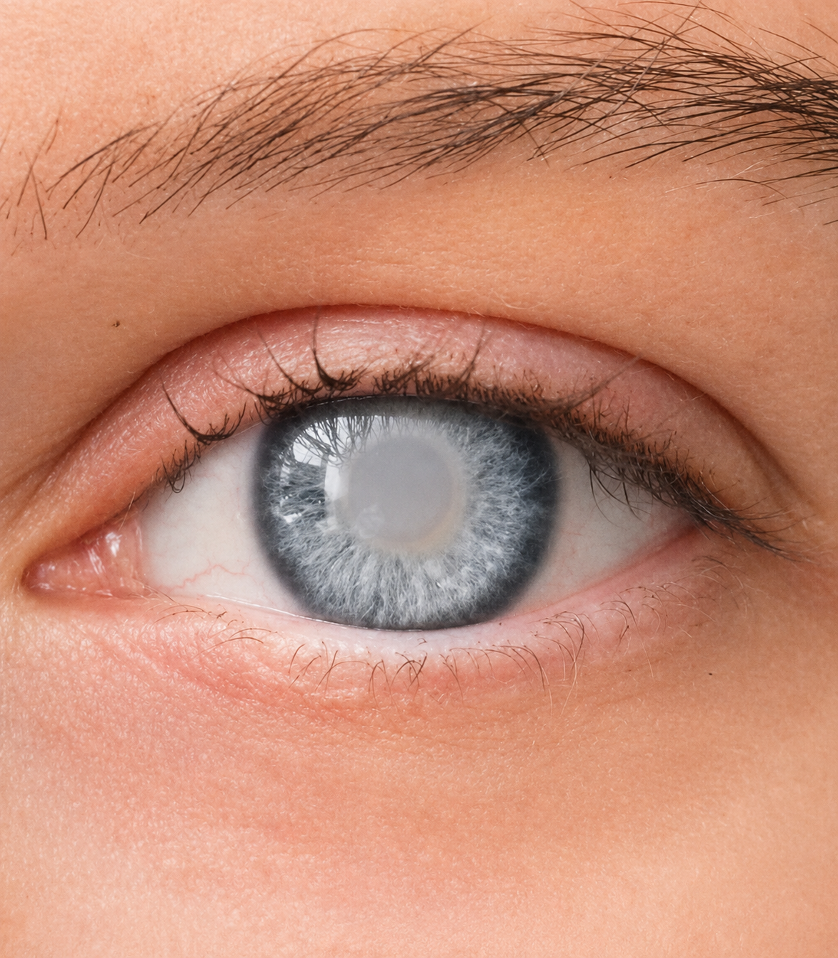 Cataract Surgery